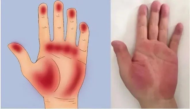 正常人的手掌呈均匀一致的淡红色,如果手掌两侧的大,小鱼际以及指尖处
