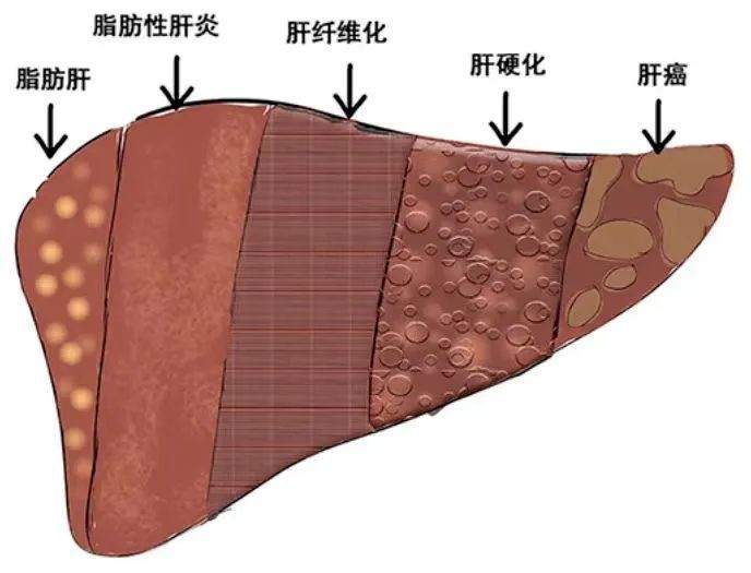 脂肪肝解剖图图片