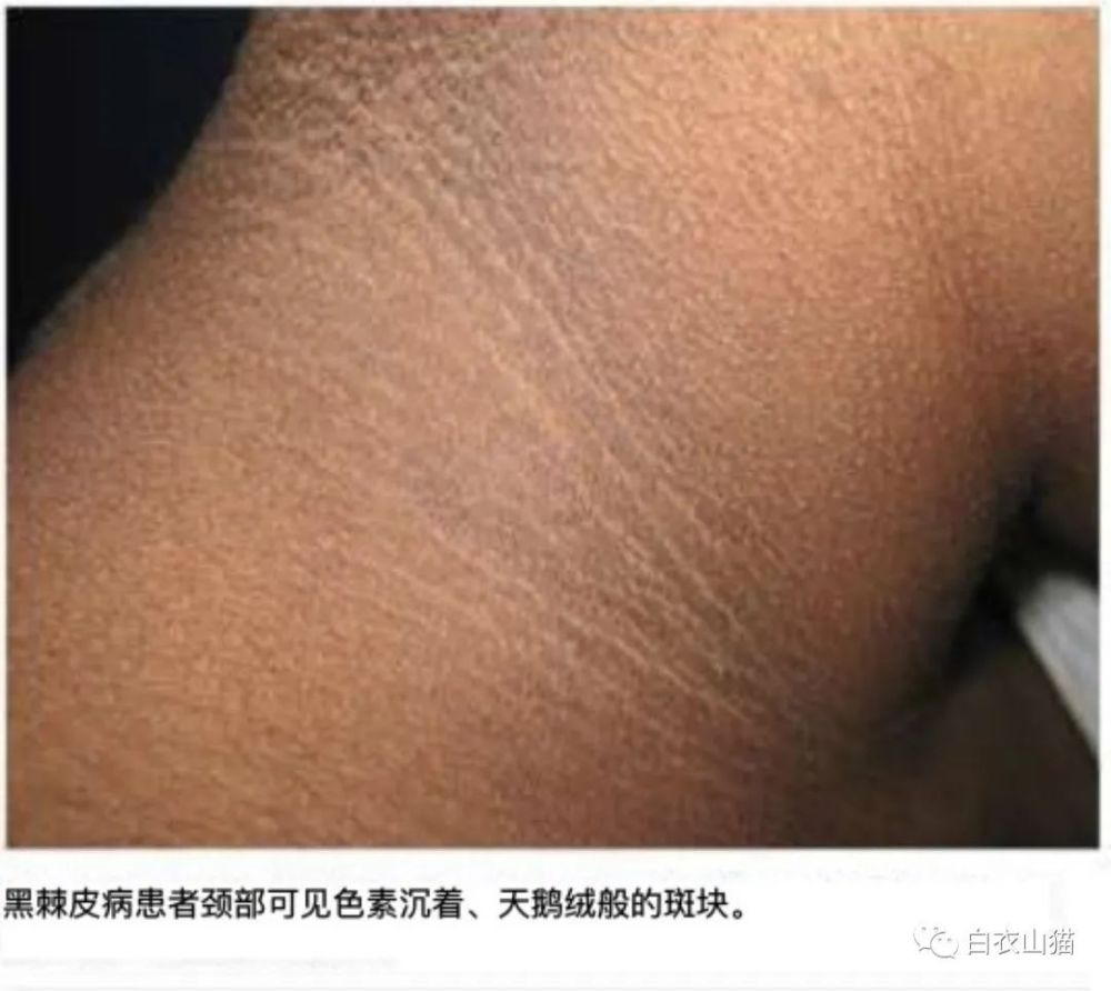 警惕如有这种黑色皮肤纹理他可能已经患上或即将患上内脏癌症