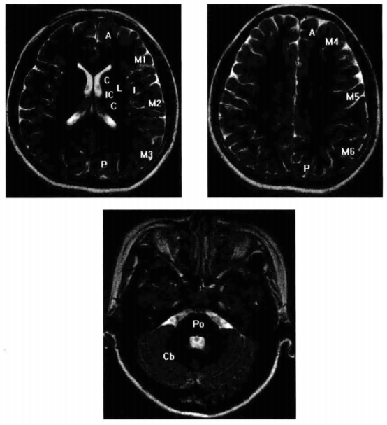 aspects,该图用mr1影像替代ct影像是为了更加清晰地展示颅内结构.