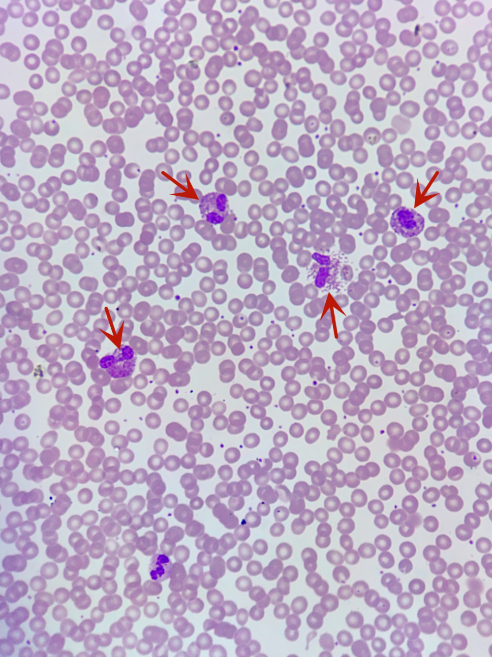 由于嗜酸性粒细胞比例异常增高,推片镜检如图2,3,嗜酸性粒细胞多见