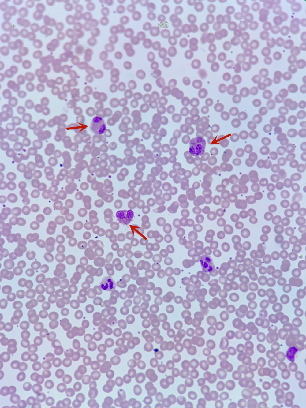 嗜酸性粒细胞红蓝图图片