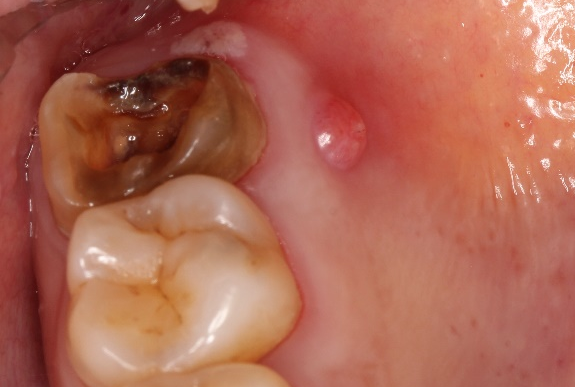 【每周科普】变"残"为宝——残冠残根的桩核冠修复_腾讯新闻