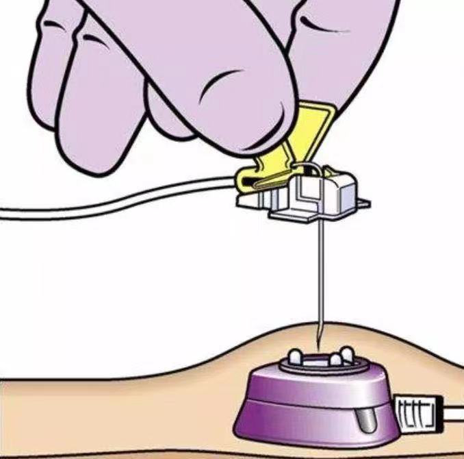 又称植入式中央静脉导管系统(central venous port access system