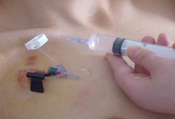 化疗如何选择静脉置管?