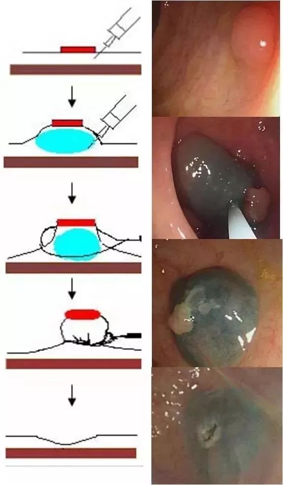 结直肠息肉内镜下切除术华西版