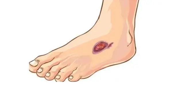 流血,溃烂或不对称性结节突起等症状;▲往日射线照过的皮肤或旧疮疤