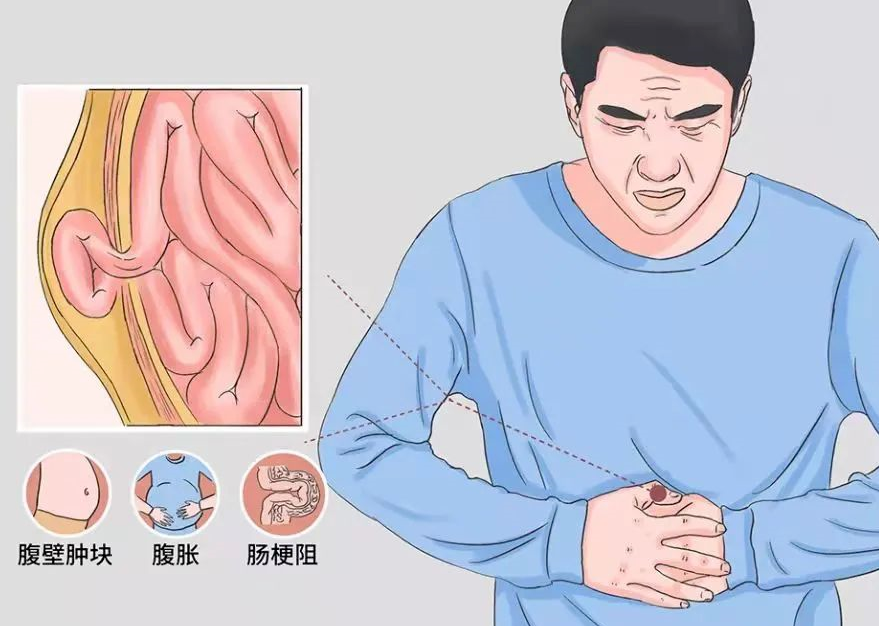 在浙大一院胃肠外科,印大爷的这颗"鸡蛋"被验明正身——右侧腹股沟疝.