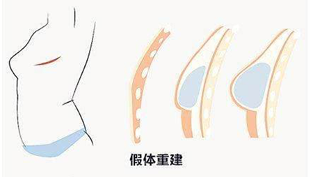 特别是不愿接受较大手术创伤,寻求简便的手术操作时,可以应用乳房假体