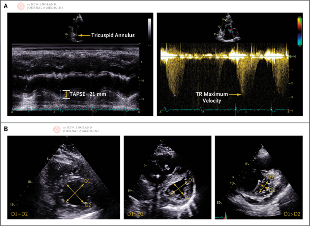 新英格兰医学杂志综述心脏右侧的衰弱在左心衰肺动脉高压及sarscov2
