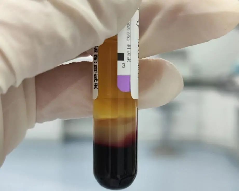 将样本上机离心,发现患者血样异常,压积红细胞上面有一层厚厚的白细胞