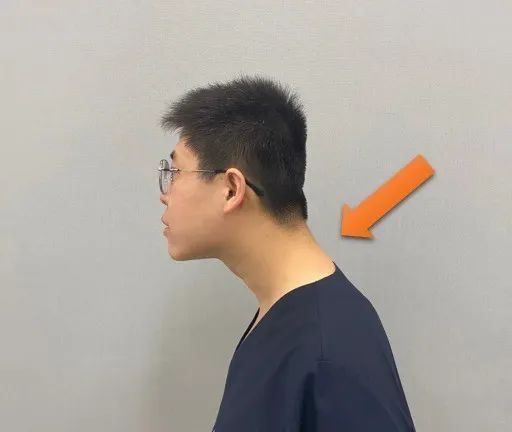 旋不良的吞咽习惯和呼吸习惯头前探可能引发体态问题日益增多导致头前