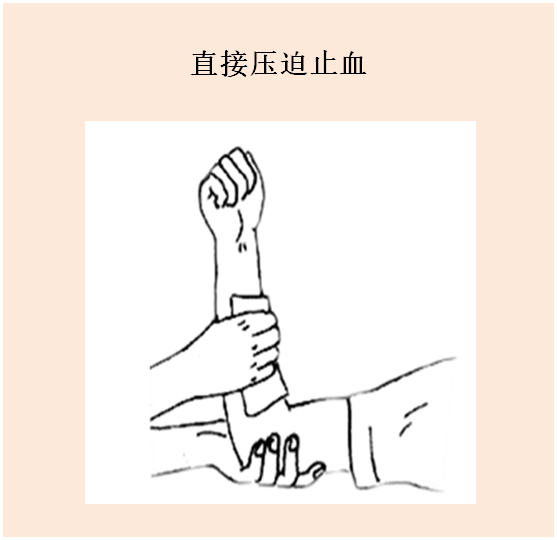 外伤急救止血“小宝典”_腾讯新闻