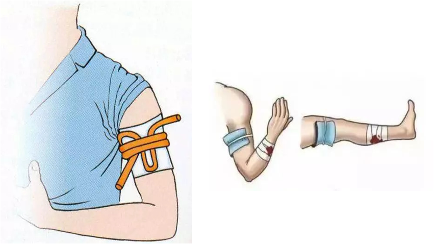 可用于四肢伤口较大,出血量较多,采用压迫止血不方便转运或效果不佳时