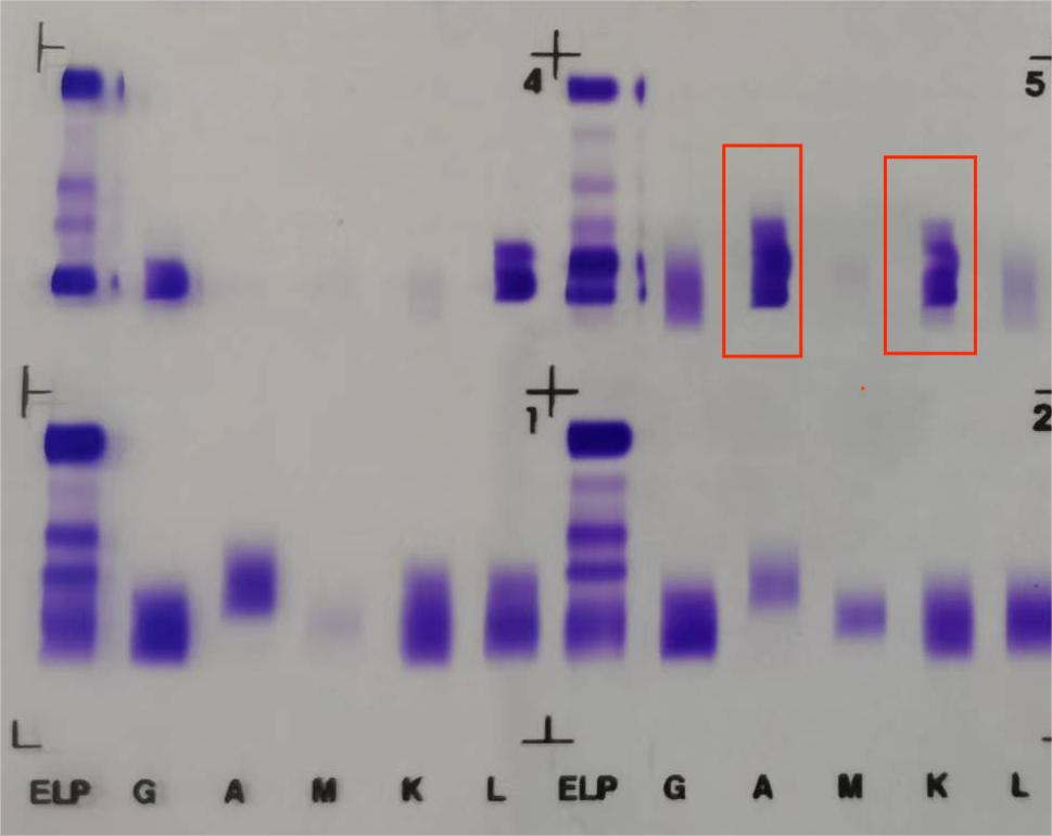 一例特殊的双条带免疫固定电泳的结果解读