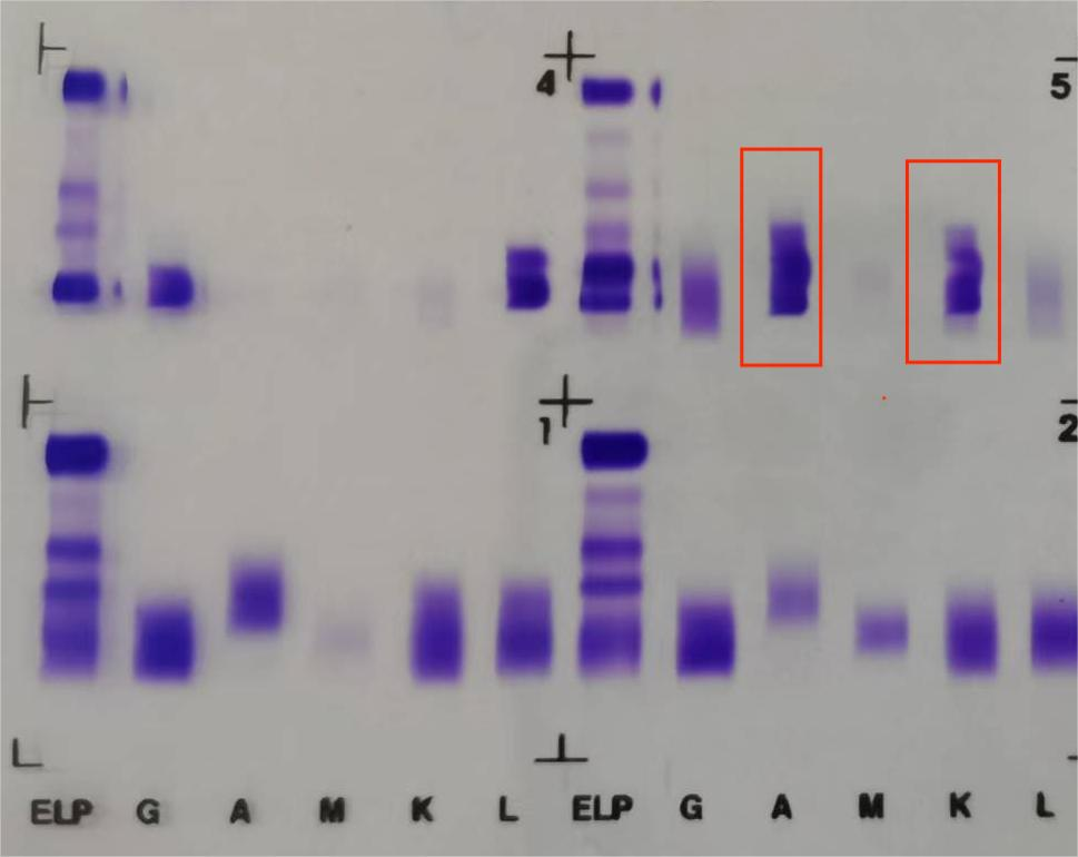 一例特殊的雙條帶免疫固定電泳的結果解讀