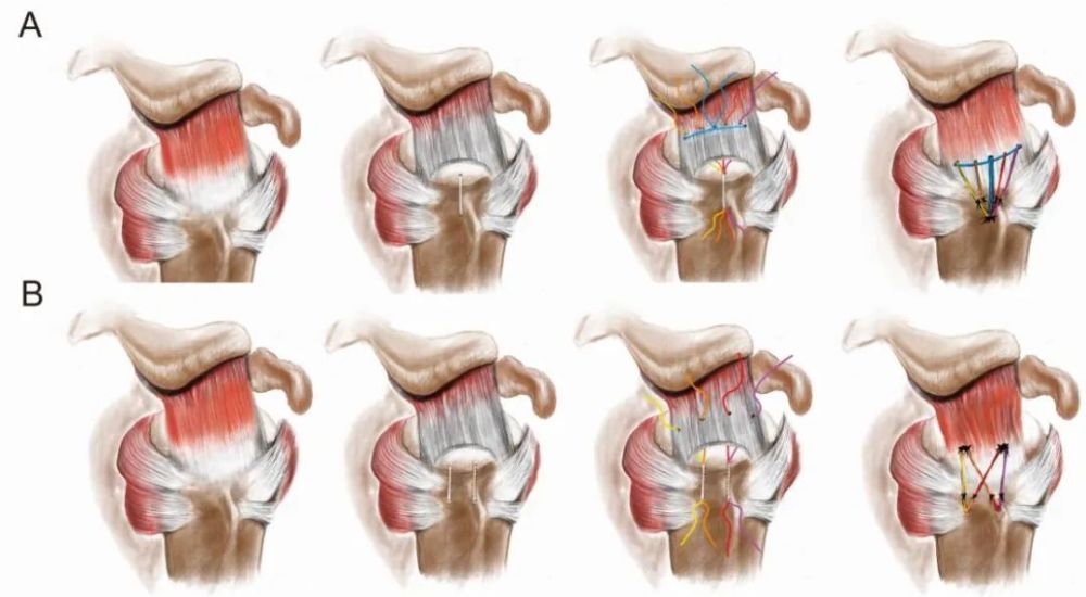 肩袖损伤带来"举手之痛",医生独创缝合技术造福患者_腾讯新闻