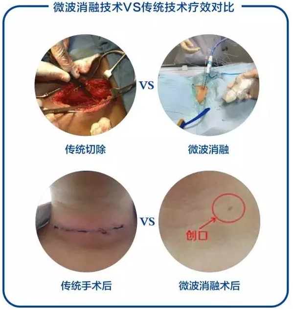 以针代刀精准消融枞阳县人民医院甲状腺微创治疗有了新手段