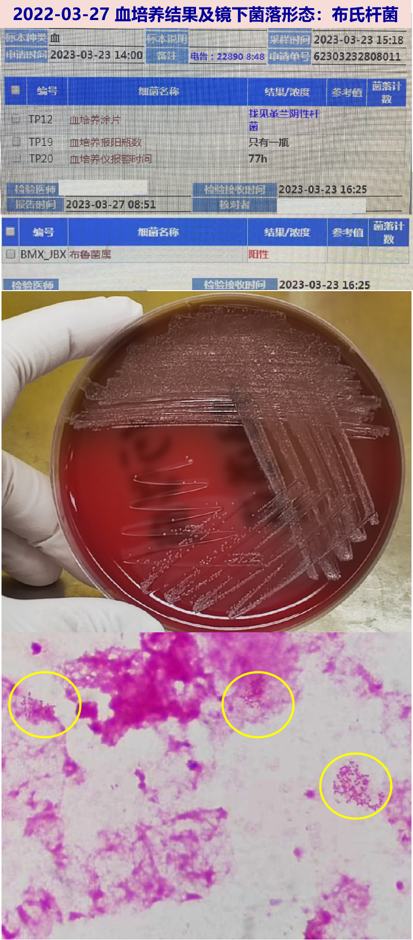 用药及体温变化情况五,最后诊断与诊断依据最后诊断:布氏杆菌感染诊断