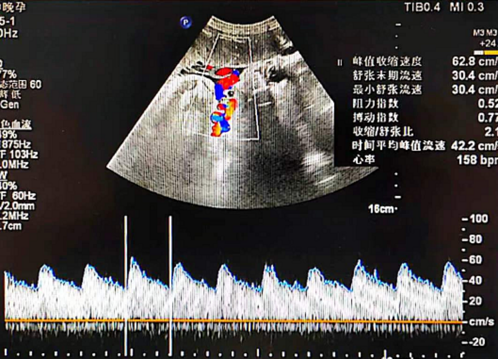 71 mm,羊水指数 79 mm 最大深度 30,胎盘左侧壁 级,脐动脉