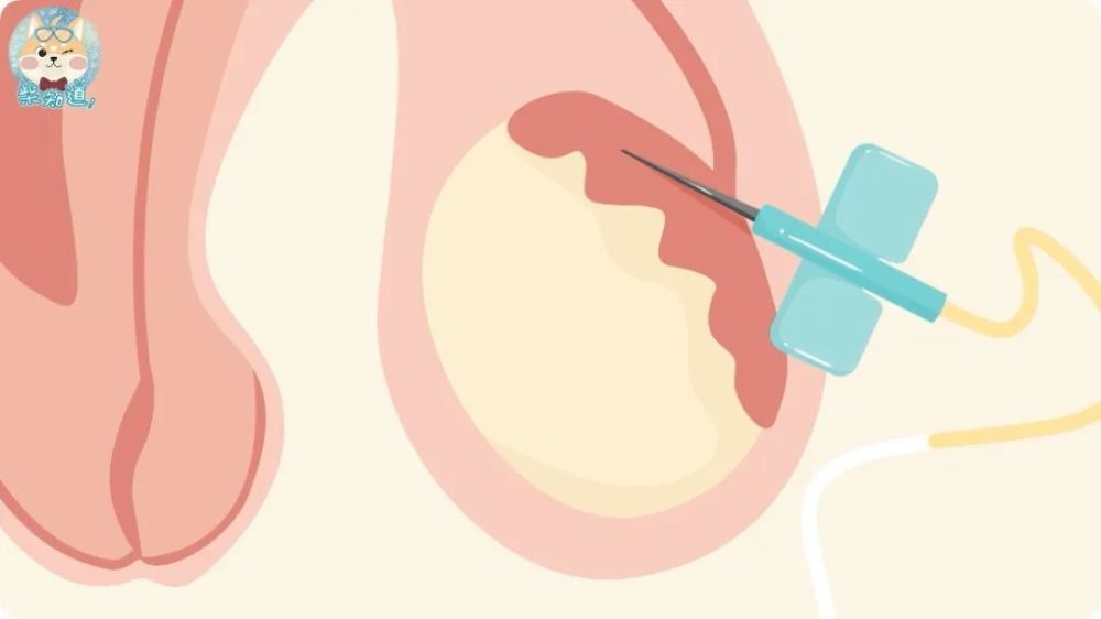 不骄不躁!睾丸穿刺取精是做试管吗"灯火辉煌"-第1张图片-枫无痕网