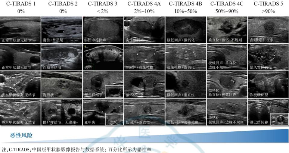 新版“C-TIRADS分类标准”与“史上最全”超声图解！评估甲状腺结节恶性风险，指南给出新建议_腾讯新闻