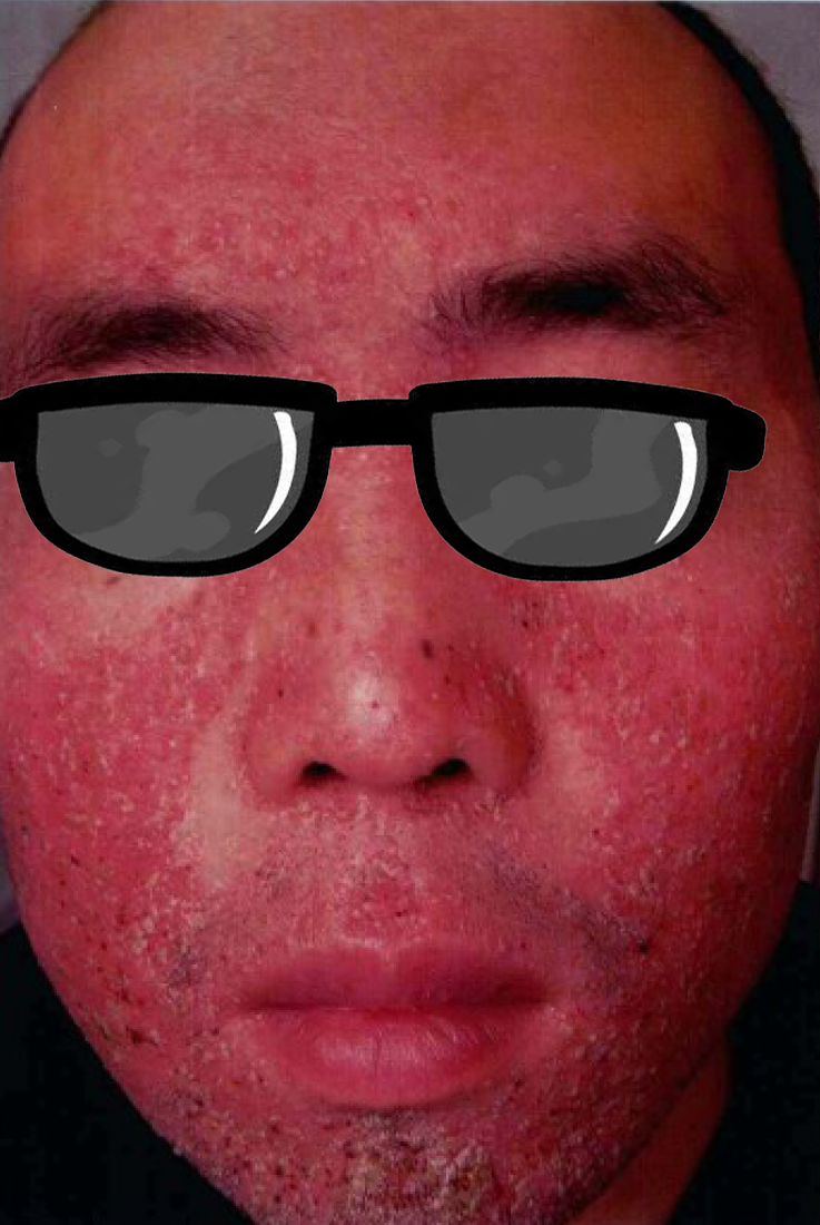 面部红斑,并非过敏这么简单