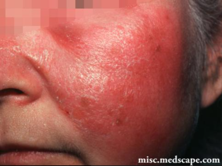 耳,手等暴露部位,表现为对称分布的,红色至紫罗兰色的斑疹,丘疹,结节