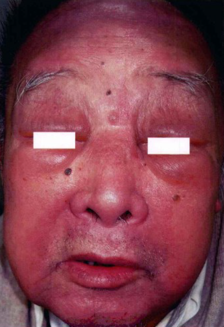 好发中老年,表现为面部红斑,紫色出血斑,丘疹,结节,常有全身浅表淋巴