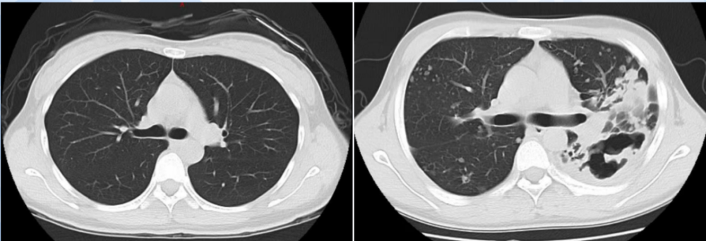 咳嗽咳痰一年未看,体检发现肺已成虫蛀样空洞……熬夜,减肥可能唤醒体