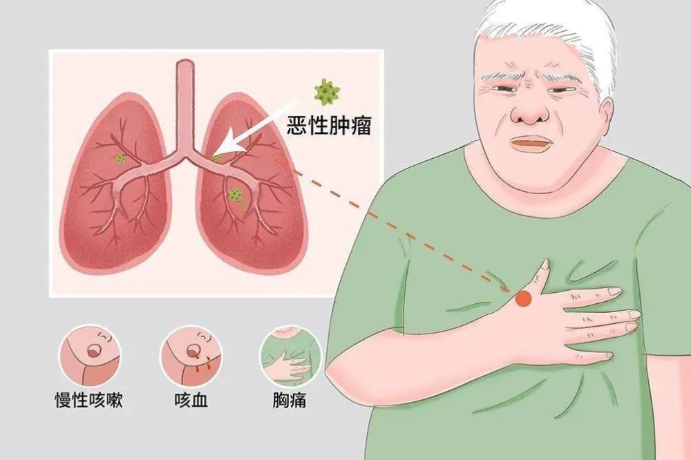 肺癌疼痛点的位置图图片