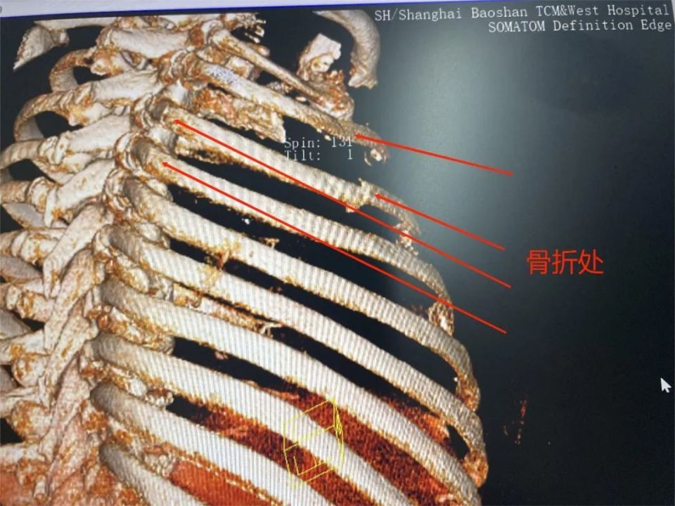上海首例！宝山区中西医结合医院成功实施一例全胸腔镜下肋骨骨折内固定手术_腾讯新闻