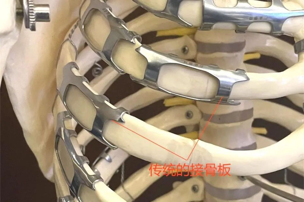 上海首例宝山区中西医结合医院成功实施一例全胸腔镜下肋骨骨折内固定