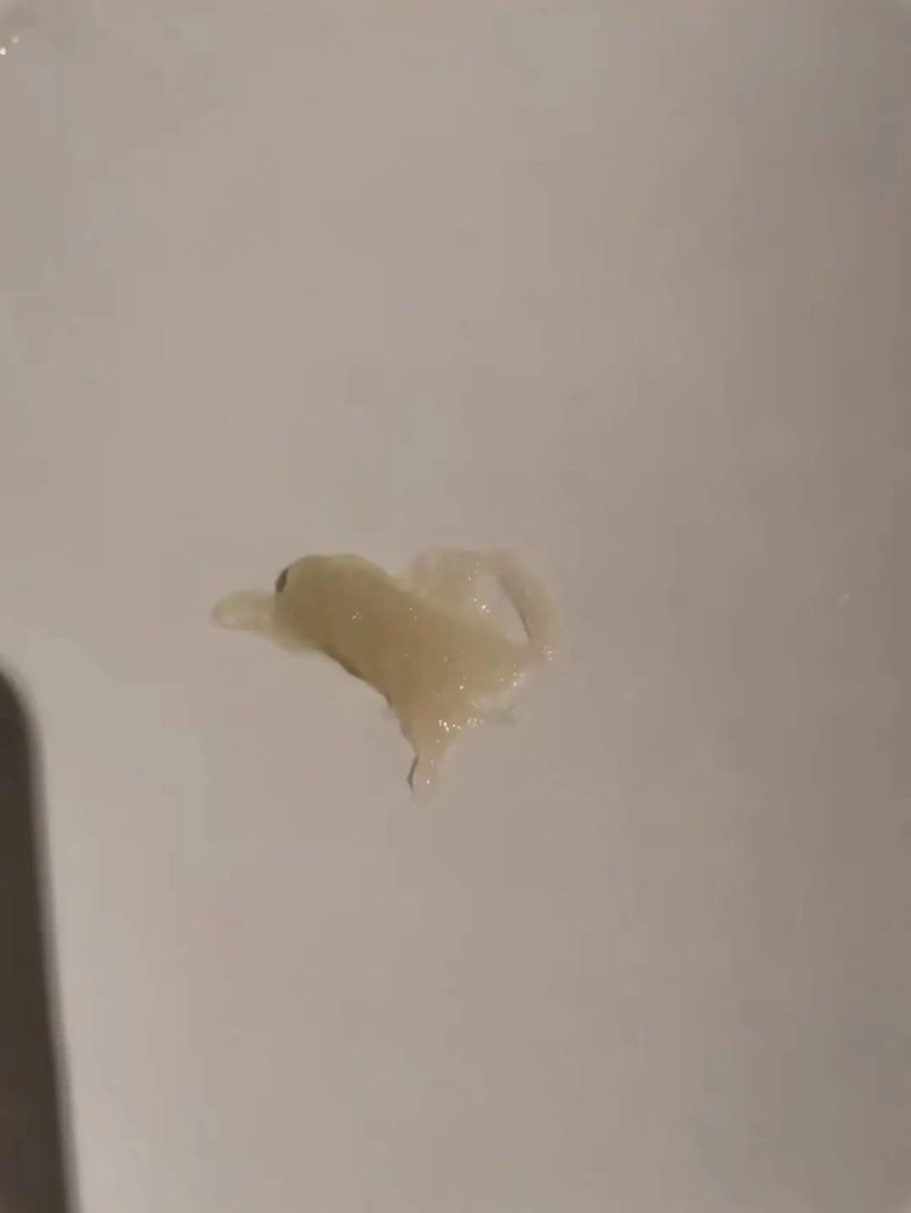 当哮喘患者咳出了"果冻样痰","啫喱样痰"甚至是"长条形铸型痰栓",这