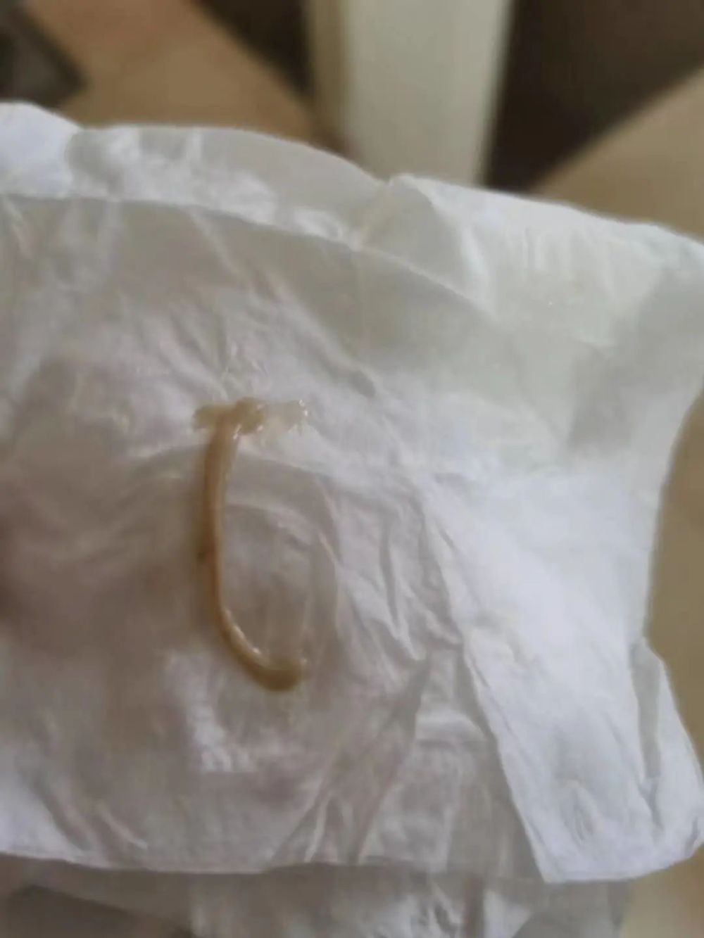 当哮喘患者咳出了"果冻样痰","啫喱样痰"甚至是"长条形铸型痰栓",这