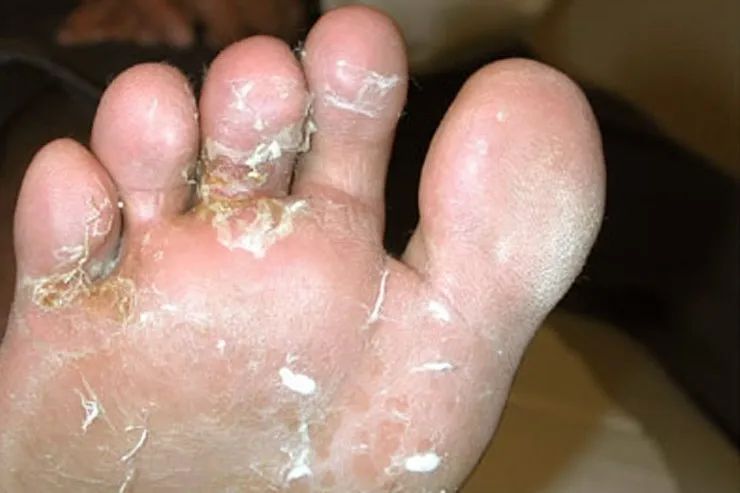 脚气反反复复不断根看看是不是这些地方没做对