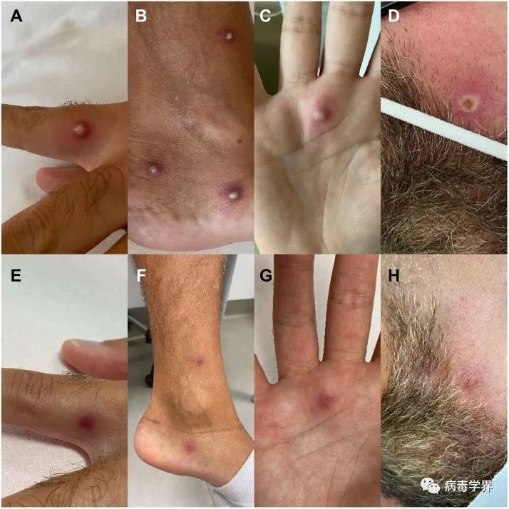 2:monkeypox skin lesions: small vesicles (panel a), reddened