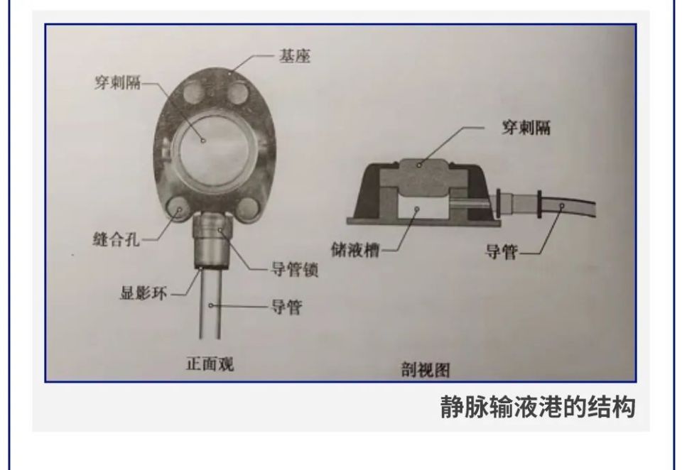 输液港的组成图片图片