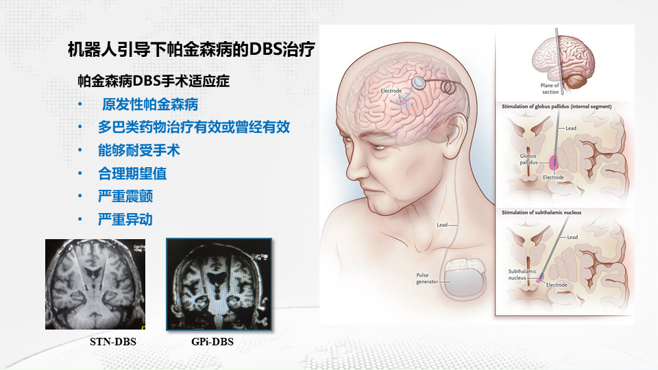 山西省人民医院神经外科功能性脑疾病和脊髓脊柱病区副主任,神经外科