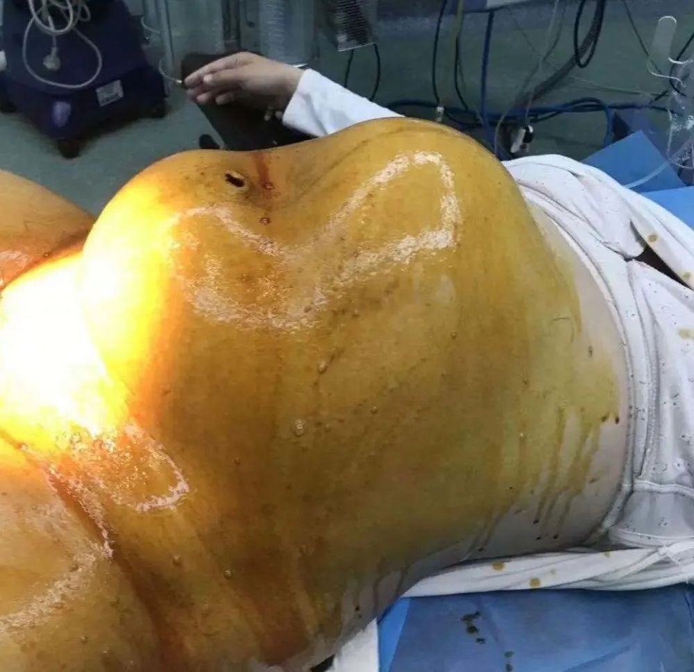 肚子像驼峰主刀切开后子宫四散裂开至今还后怕