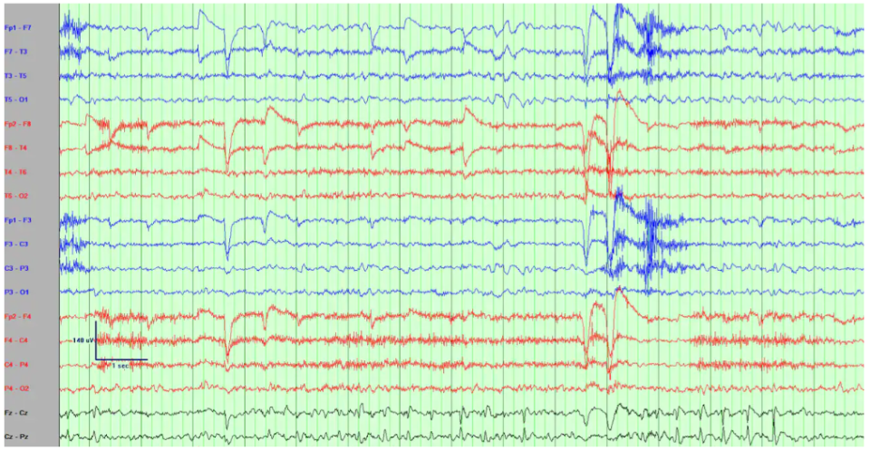 图文并茂|多图详解常见成人局灶性癫痫脑电图特征
