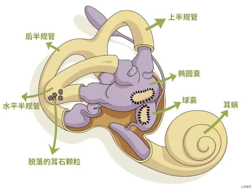 一些非常小的微粒叫耳石,当这些微小的零件脱落进入半规管转圈流动