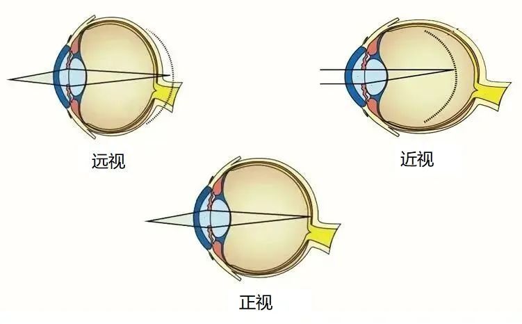 远视眼是怎么回事图片