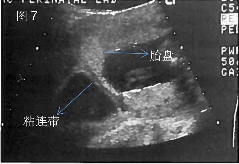 随着子宫增大,粘连组织弹性欠佳,其周围胎膜受力不均则可能导致胎膜早