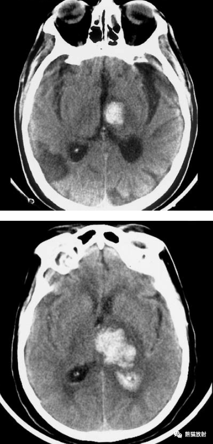 由海绵状血管瘤破裂引起的iph.22岁女性,内囊后肢局部出血性病变.