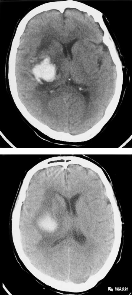 脑实质内出血丨演变,分布,ct表现