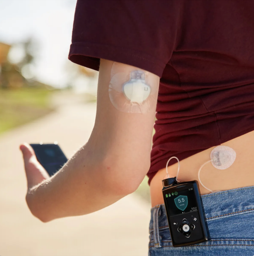 糖尿病创新医疗器械美敦力胰岛素泵系统minimed780g获批fda-讯华