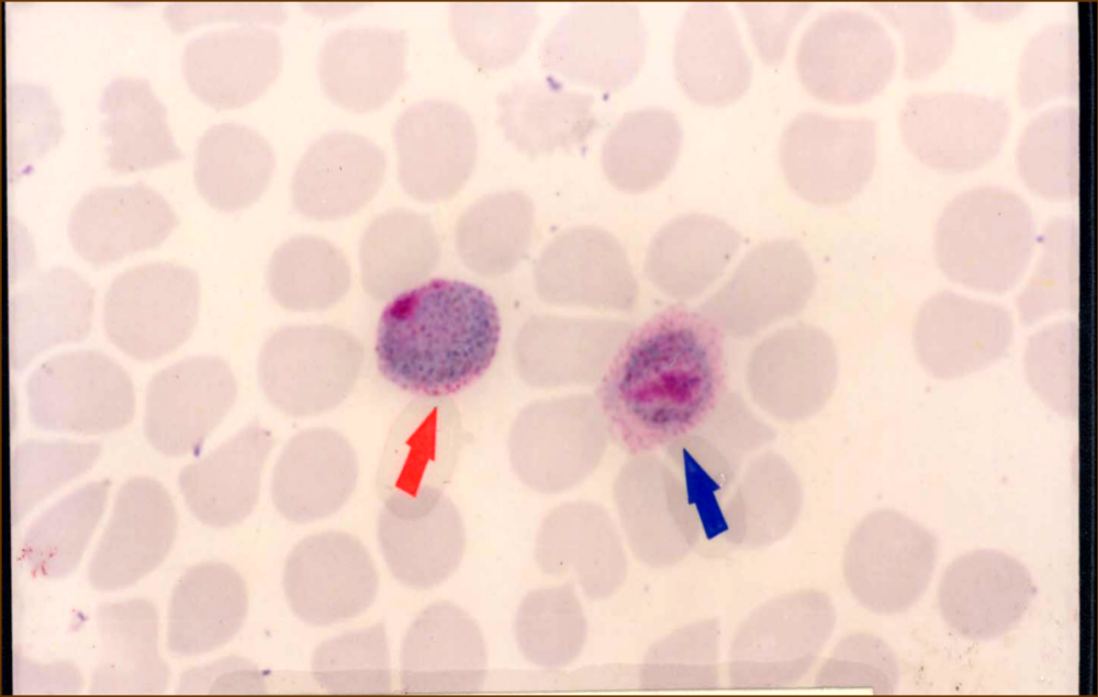 疟原虫环状体根据感染的疟原虫种类不同,疟疾可分为间日疟,恶性疟