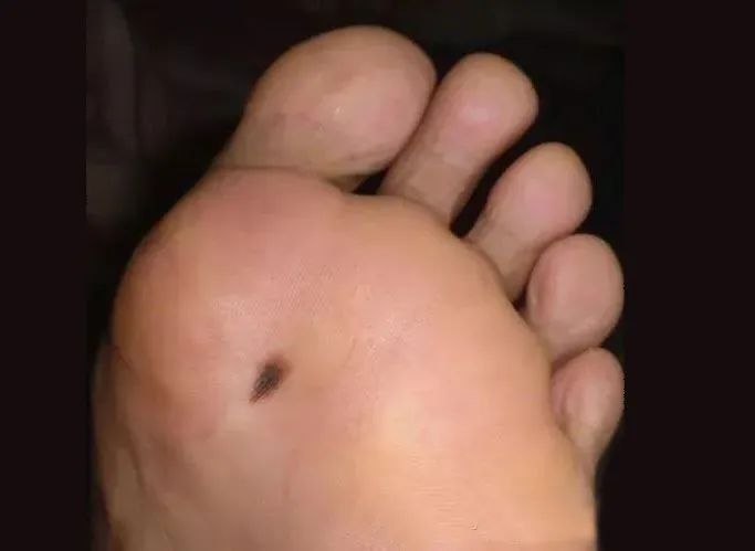 警惕脚趾甲上突然出现黑线小心会癌变