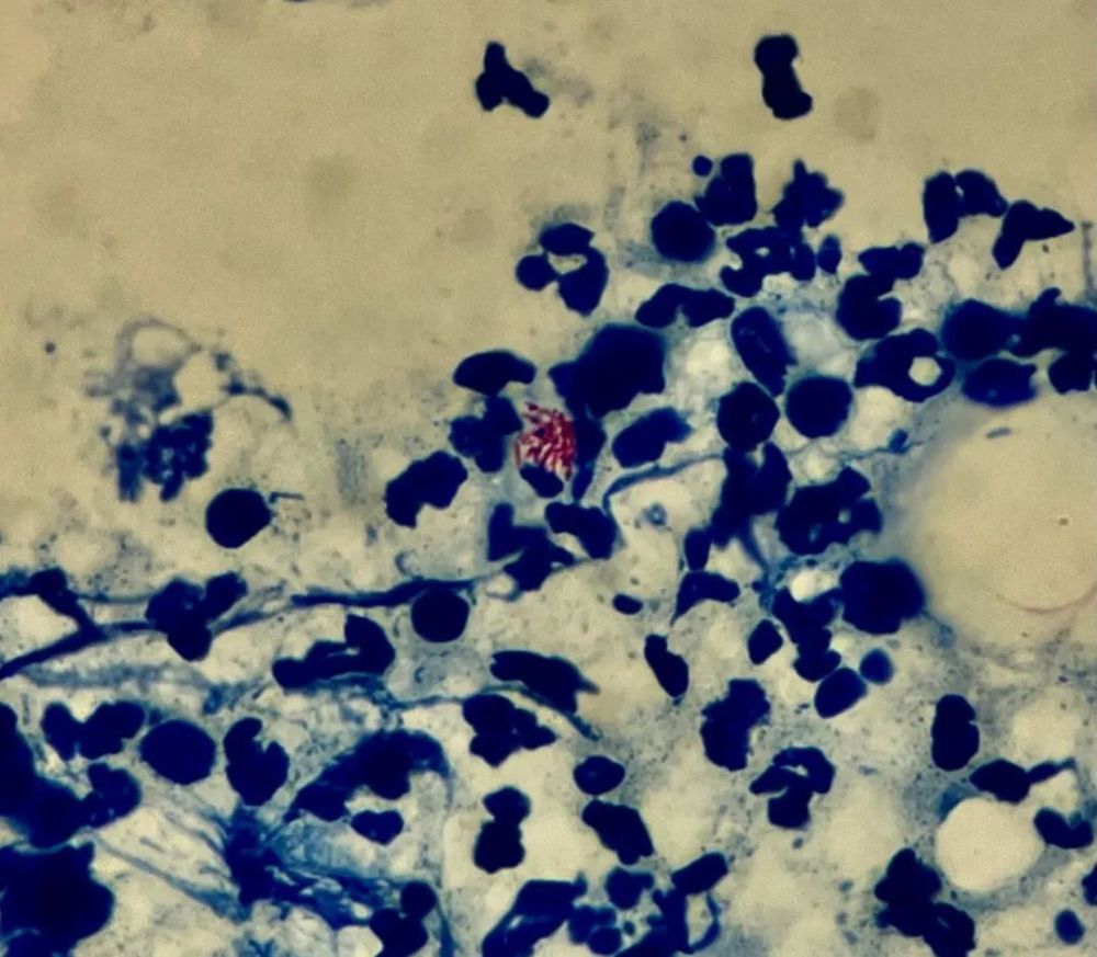 检验科收到脓液标本后,进行革兰,抗酸染色涂片,脓液直接涂片:找到g